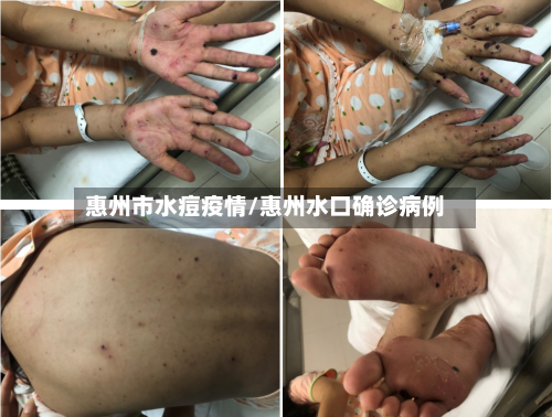 惠州市水痘疫情/惠州水口确诊病例